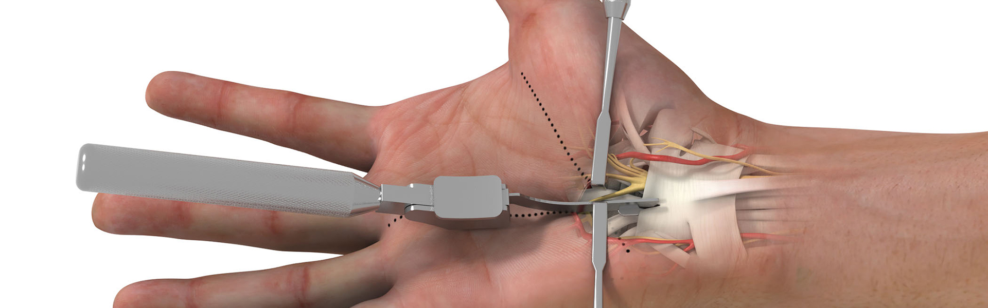 The Future of Minimally Invasive Surgery Helping Patient - 4 | S2S Surgical