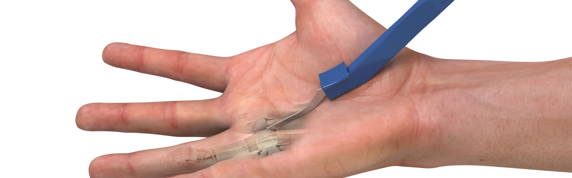 The Future of Minimally Invasive Surgery Helping Patient - 1 | S2S Surgical