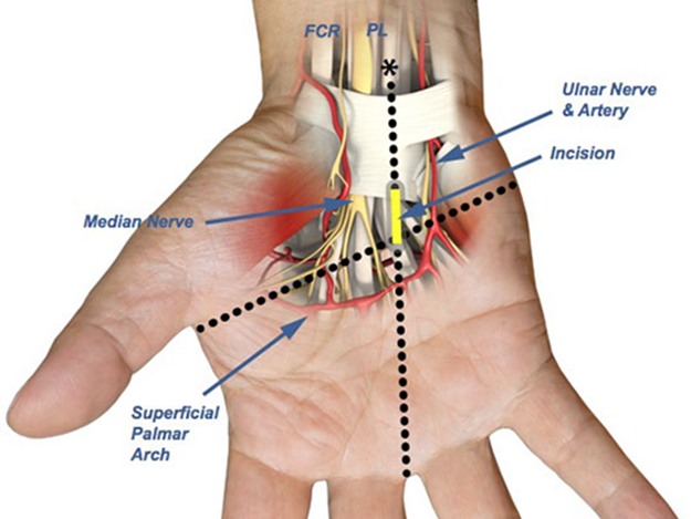 Palmar Fascia Sparing Technique